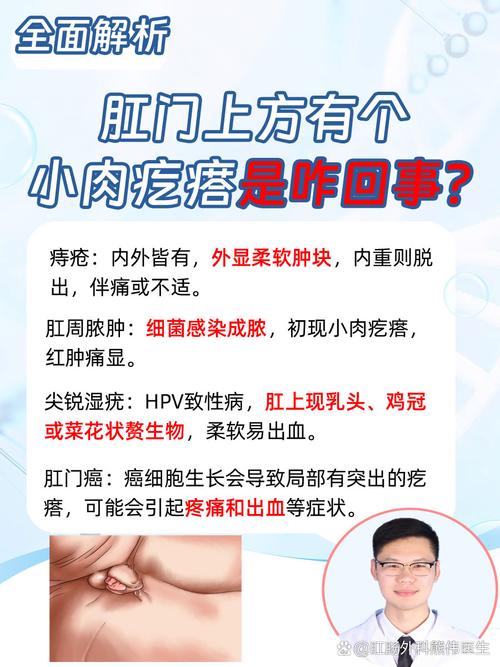 痔疮外痔消除时间有多长？