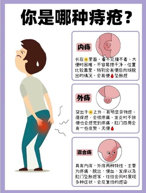 看痔疮：必须当场指检吗？