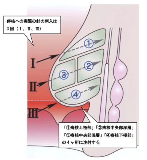 环状痔疮注射疗法效果如何？