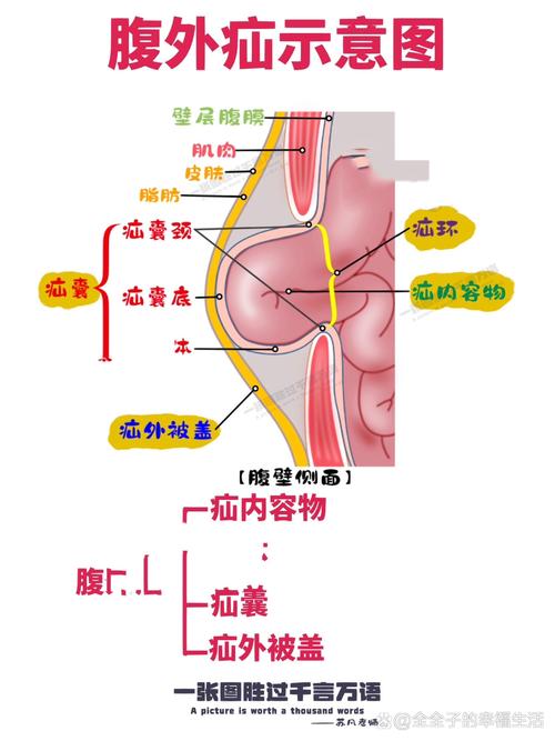 腹壁疝