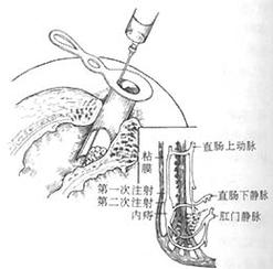 枯痔治疗