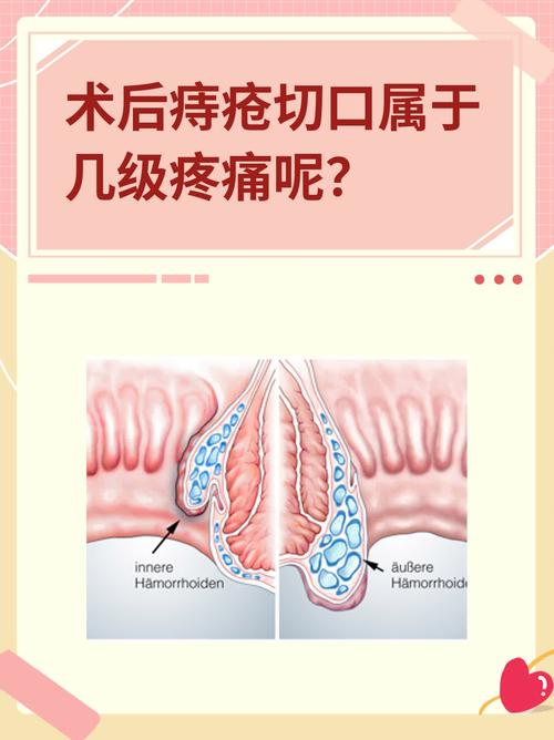 痔疮切口疼痛