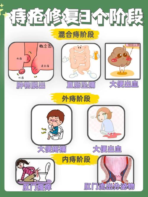 如何在不同年龄段治疗痔疮？