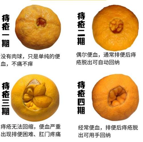 宝宝便秘与痔疮有关系吗？