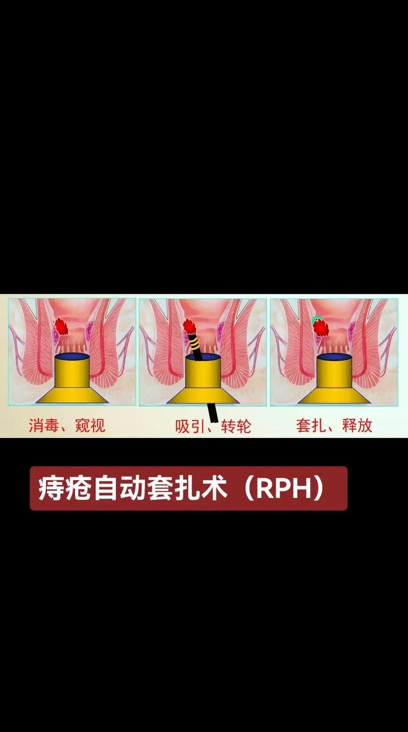 痔疮介入治疗技术