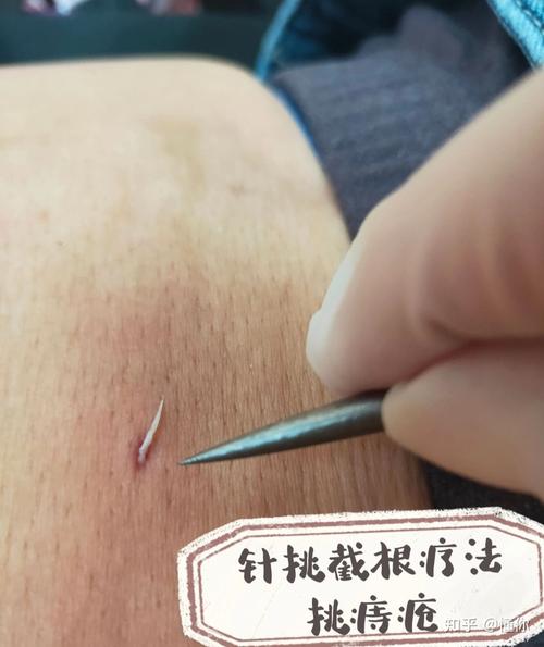 针挑治疗痔疮管用吗？效果如何？