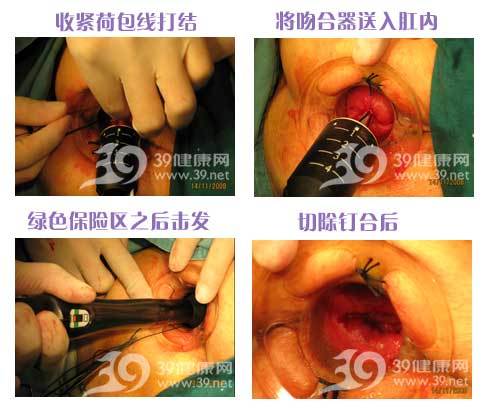 肛交与痔疮：这是双刃剑吗？