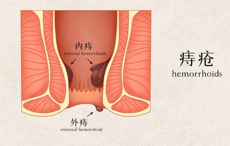 哪些痔疮患者的症状像鸡冠花？