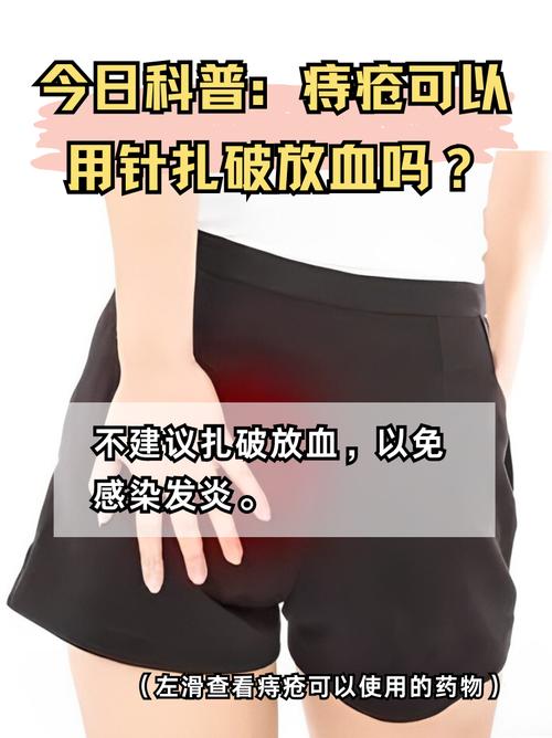 外痔疮扎破能立即缓解吗？