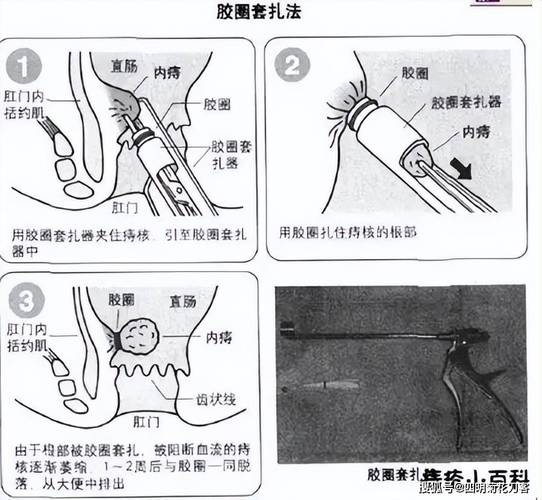 如何加速痔疮外伤口愈合？